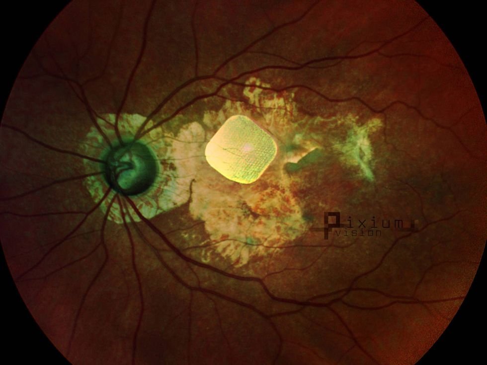 A photograph of a retina with blood vessels.  A yellow patch is located close to the center of the retina.